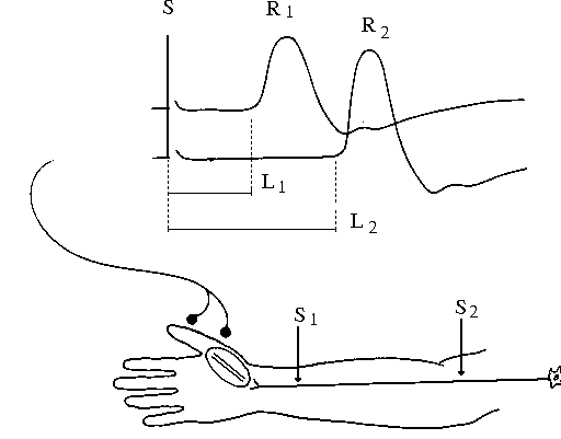 Hình 1: Đo dẫn truyền thần kinh vận động dây thần kinh giữa, ghi đáp ứng co cơ ở ô mô cái, kích thích điện vào dây giữa ở 2 điểm: S1 là kích thích điện ở cổ tay, S2 là kích thích điện ở khuỷu tay. Tương ứng trên màn hình và giấy ghi ta có đáp ứng co cơ R1 và R2. Thời gian tiềm là khoảng thời gian từ lúc có kích thích tới lúc có đáp ứng co cơ, ta có tương ứng là L1 và L2, trong đó L1 chính là DML. Hiệu số l = L2-L1 (tính bằng ms) là khoảng thời gian xung điện đi từ khuỷu (điểm S2) tới cổ tay (điểm S1). 