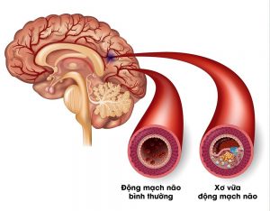 Xơ vữa mạch máu não – Nguyên nhân hàng đầu gây đột quỵ não