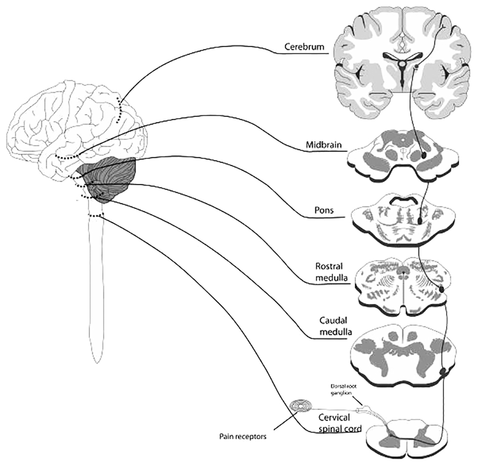 Đau sau đột quỵ (Post Stroke Pain)