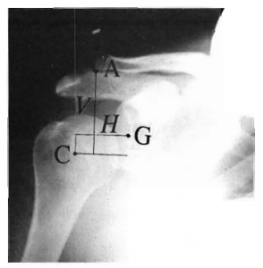 Đau sau đột quỵ (Post Stroke Pain)