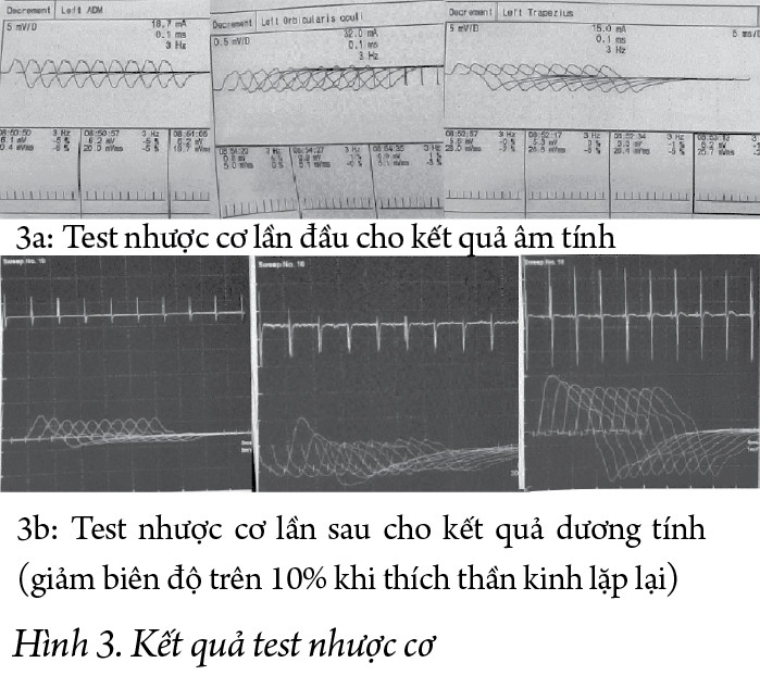 Báo cáo một trường hợp nhược cơ mới khởi phát sau nhiễm SARS-CoV-2 tại thành phố Hồ Chí Minh