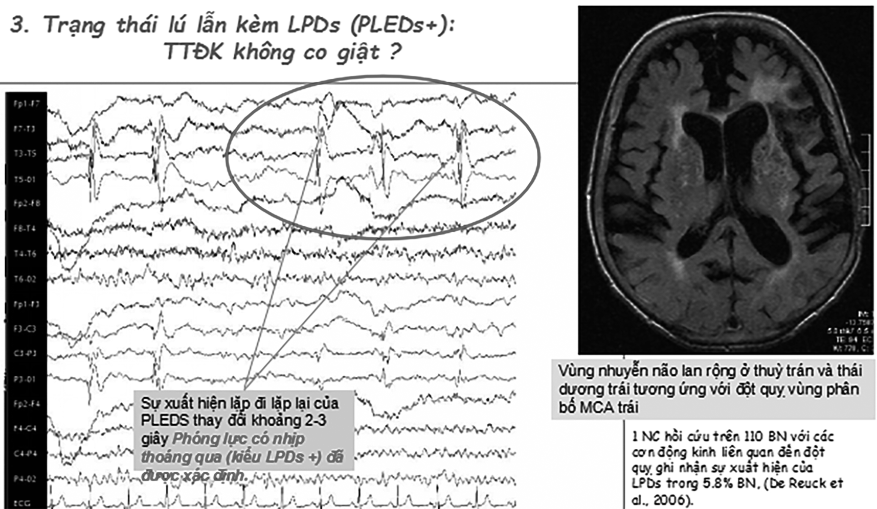 Các cơn động kinh sau đột quỵ (Post -stroke epilepsies: PSE)