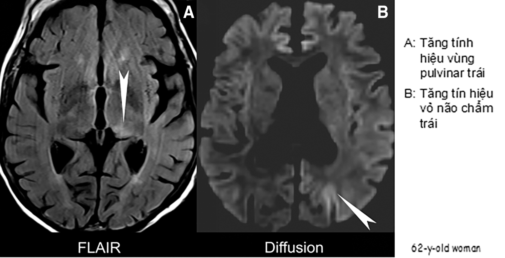 Các cơn động kinh sau đột quỵ (Post -stroke epilepsies: PSE)