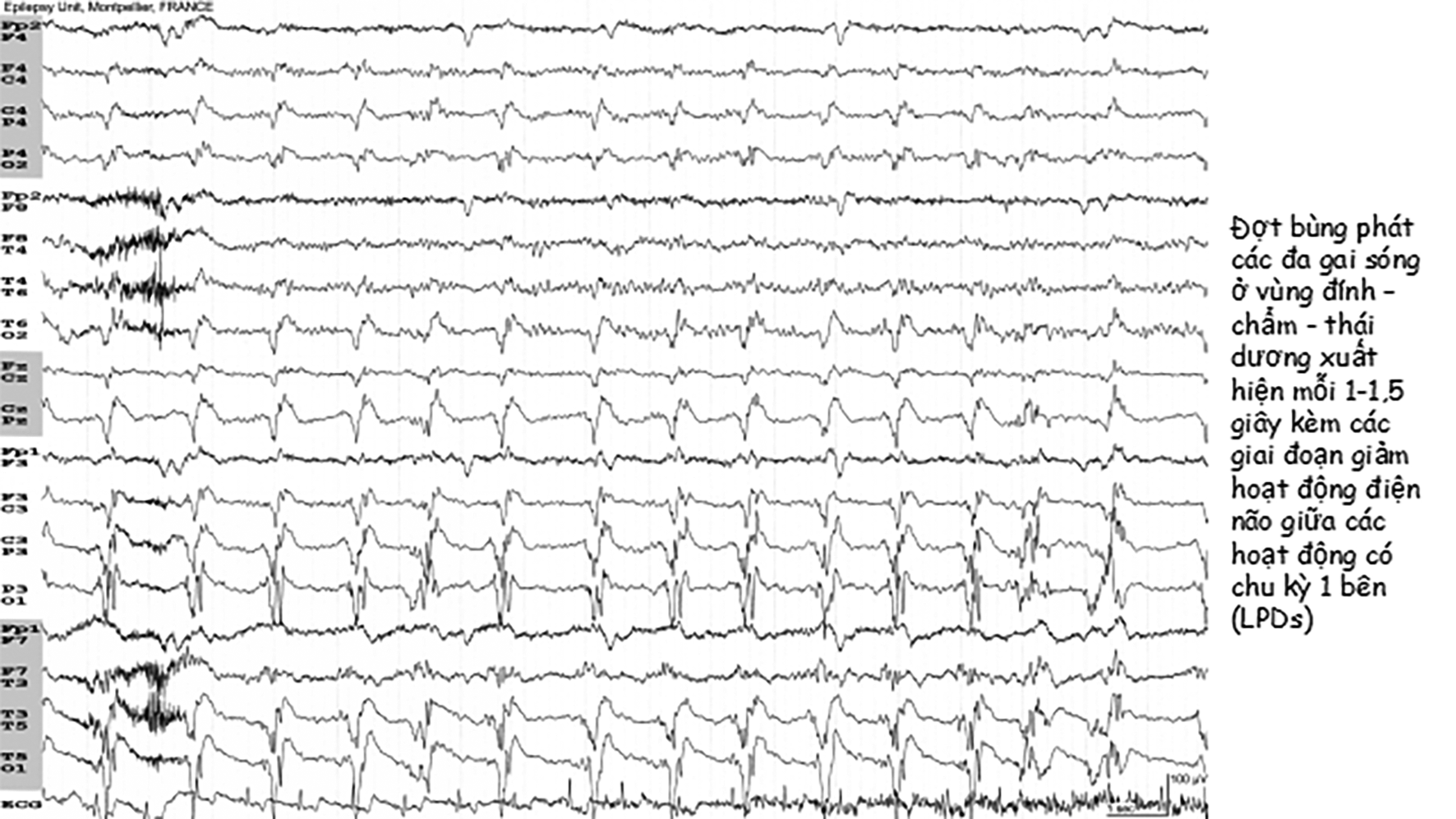 Các cơn động kinh sau đột quỵ (Post -stroke epilepsies: PSE)