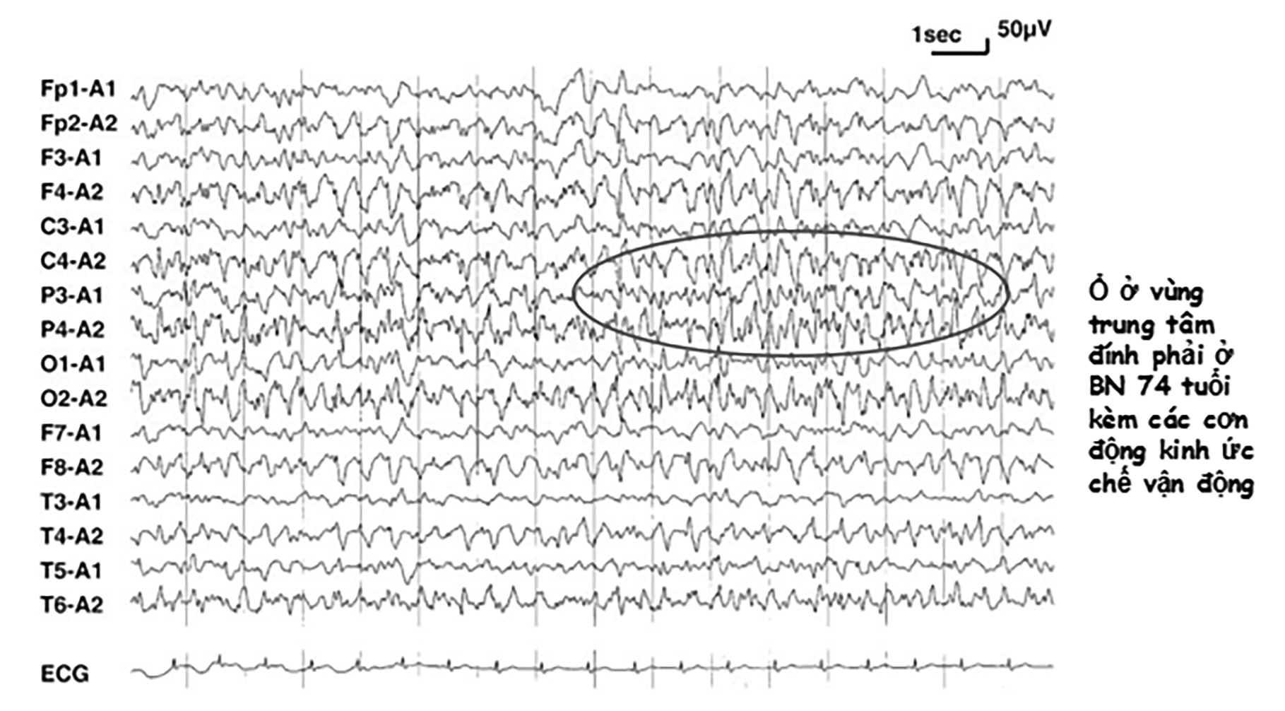 Các cơn động kinh sau đột quỵ (Post -stroke epilepsies: PSE)