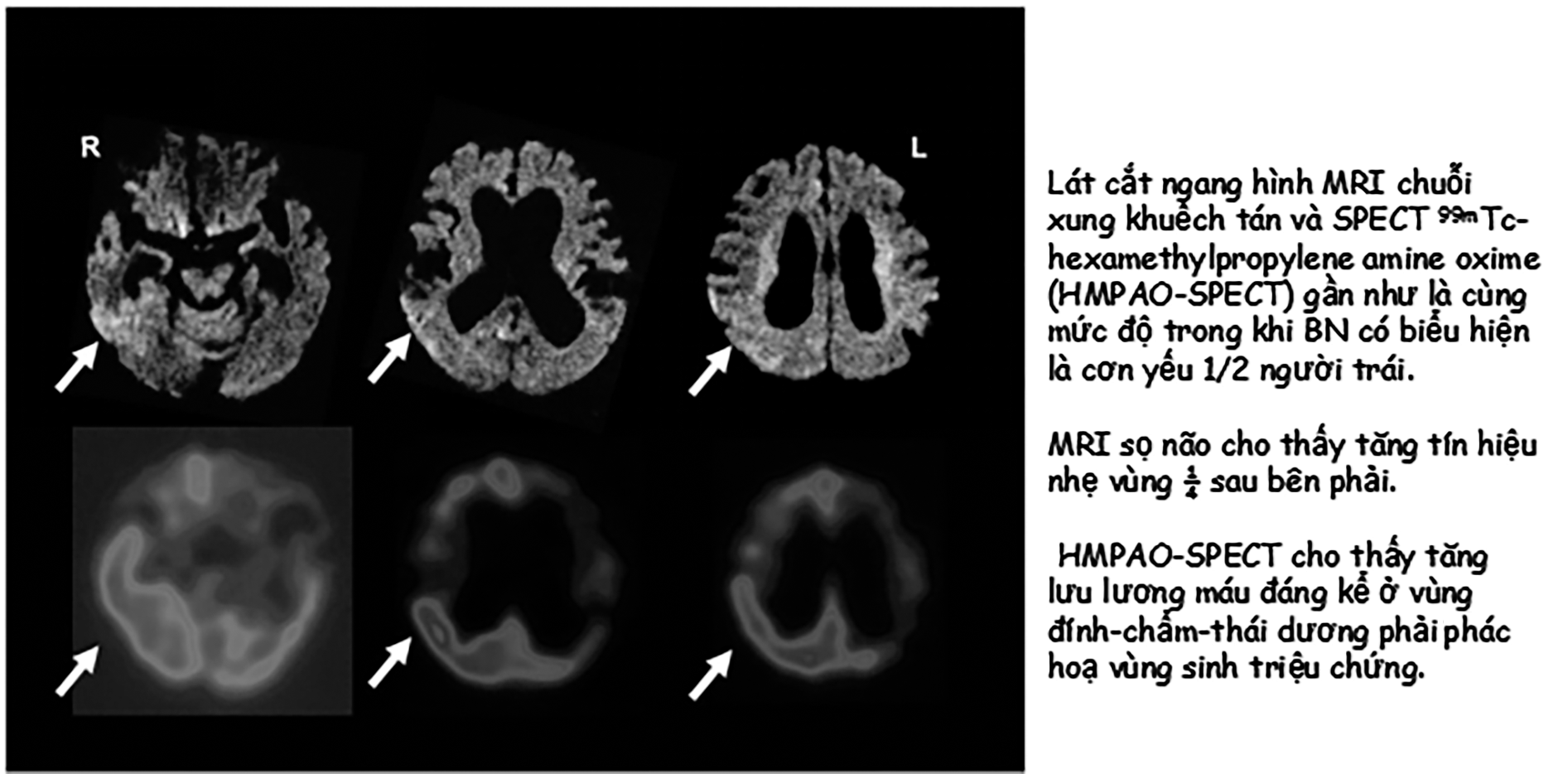 Các cơn động kinh sau đột quỵ (Post -stroke epilepsies: PSE)