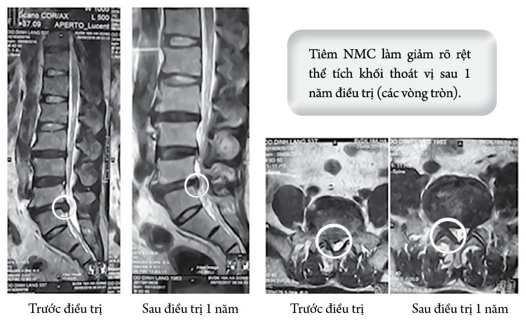 Hiệu quả điều trị thoát vị đĩa đệm cột sống thắt lưng bằng liệu pháp tiêm ngoài màng cứng