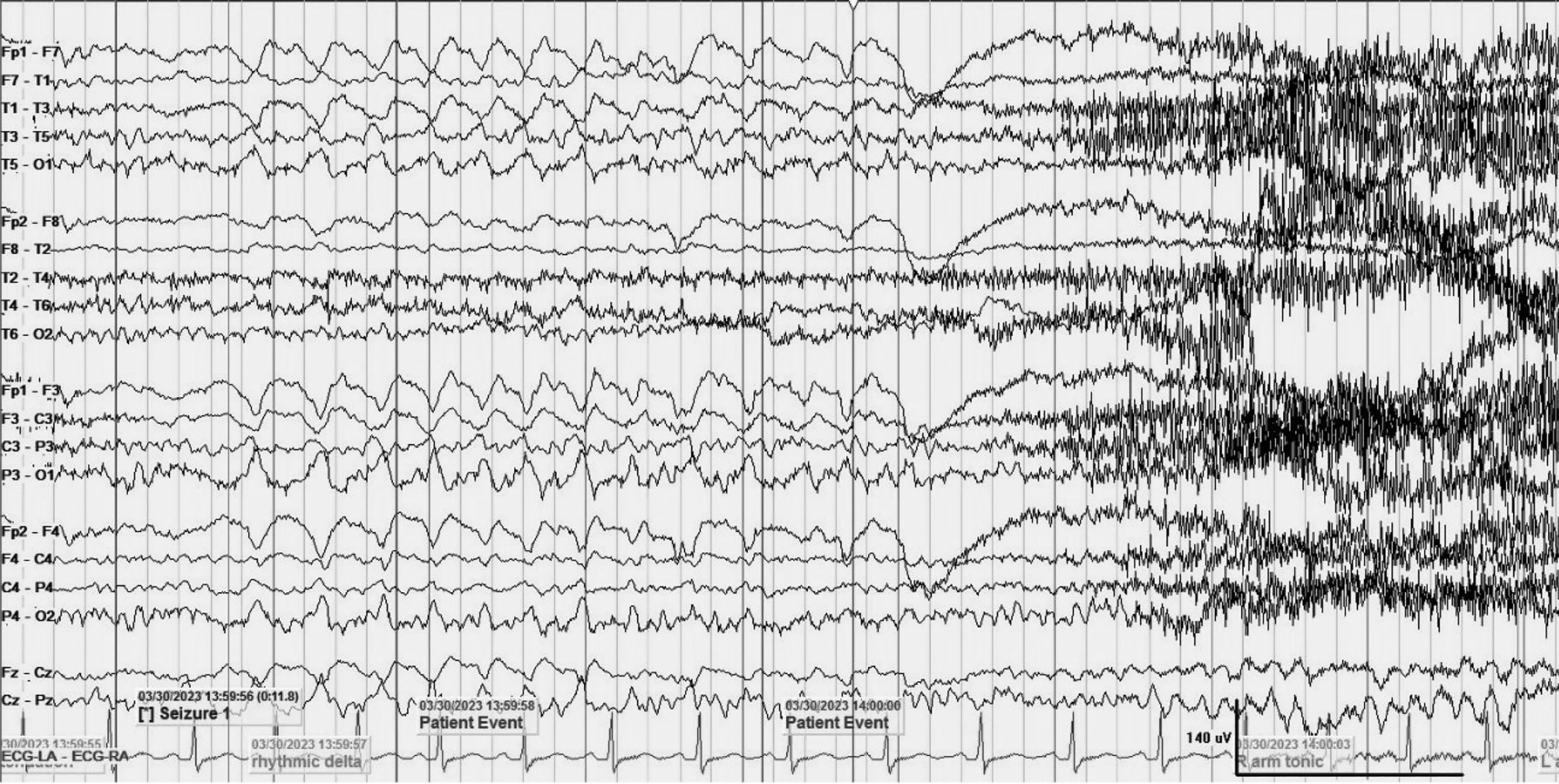 Tăng khả năng phát hiện loạn sản vỏ não khu trú kín đáo với protocol MRI HARNESS trên MRI 3 Tesla: Ca lâm sàng