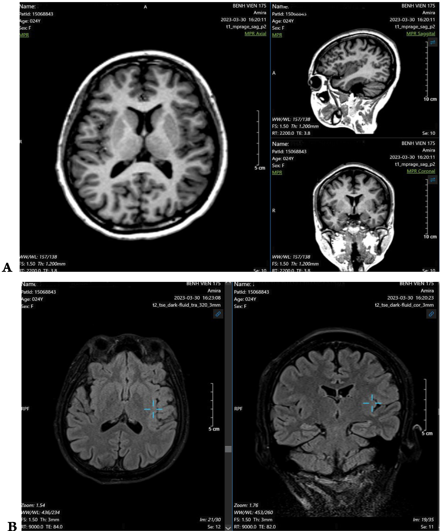 Tăng khả năng phát hiện loạn sản vỏ não khu trú kín đáo với protocol MRI HARNESS trên MRI 3 Tesla: Ca lâm sàng