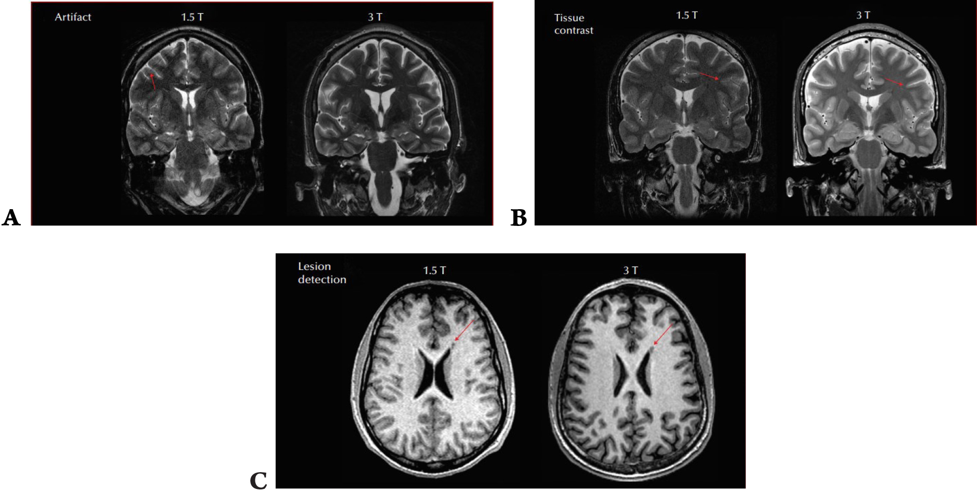 Tăng khả năng phát hiện loạn sản vỏ não khu trú kín đáo với protocol MRI HARNESS trên MRI 3 Tesla: Ca lâm sàng