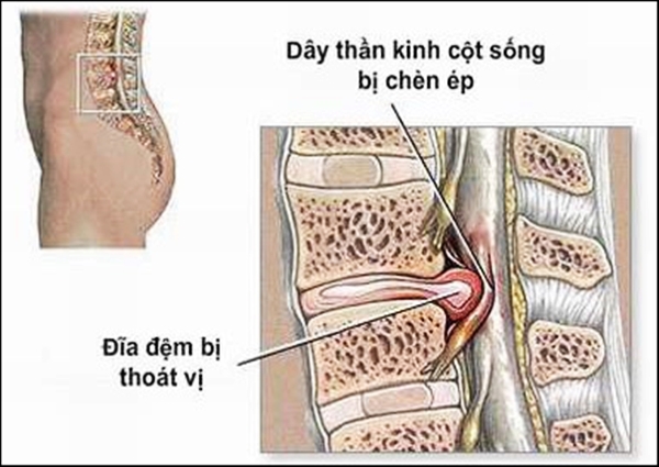 Nghiên cứu hiệu quả của điều trị thoát vị đĩa đệm cột sống thắt lưng bằng phương pháp kết hợp điện châm với kéo dãn cột sống