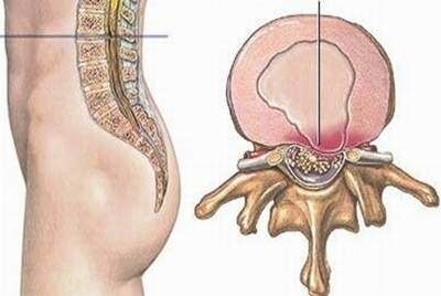 Khảo sát hội chứng chân không yên trên bệnh nhân bệnh lý rễ thắt lưng cùng