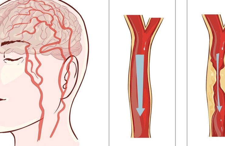 Hội chứng Parkinson do mạch máu