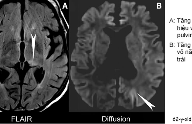 Các cơn động kinh sau đột quỵ (Post -stroke epilepsies: PSE)