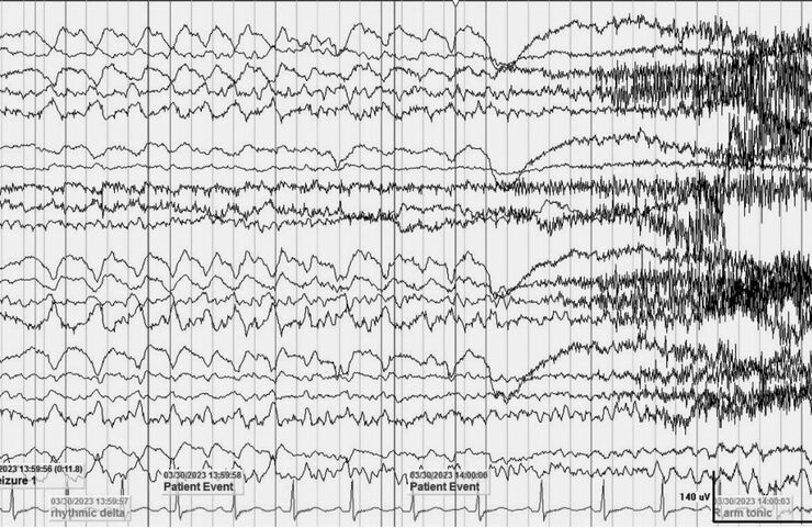 Tăng khả năng phát hiện loạn sản vỏ não khu trú kín đáo với protocol MRI HARNESS trên MRI 3 Tesla: Ca lâm sàng