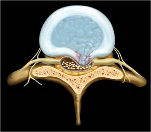 Phân chia mức độ chèn ép thần kinh trên phim chụp cộng hưởng từ ở các bệnh nhân thoát vị đĩa đệm cột sống