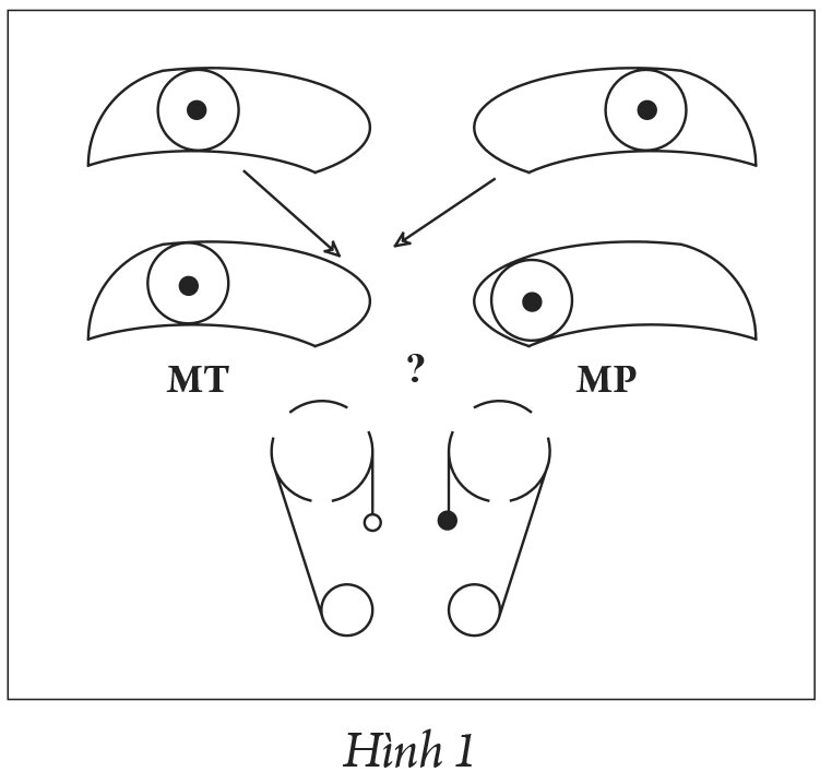 Liệt chức năng nhìn
