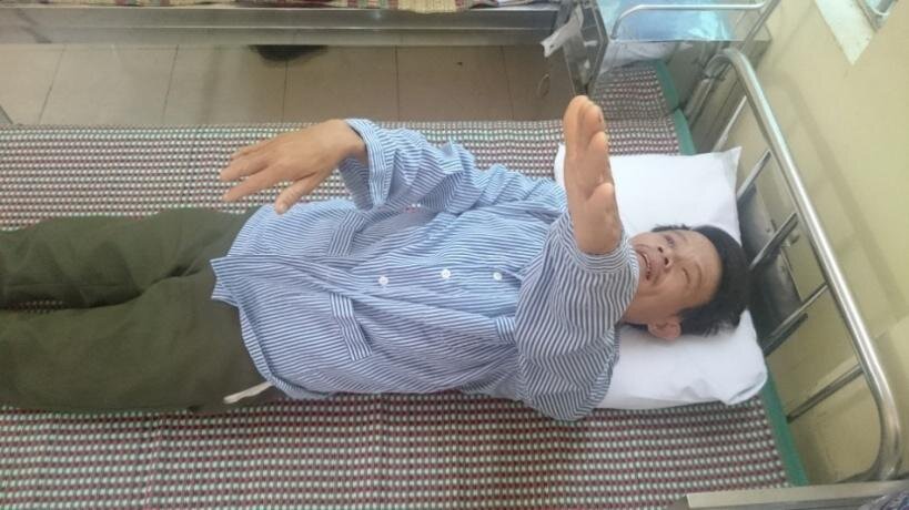 Hội chứng giao bên Brissaud-sicard: lý thuyết và thực tế quan sát tại Bệnh viện 198 Bộ Công an