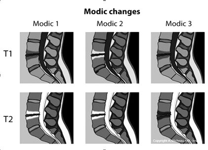 Nghiên cứu một số đặc điểm thay đổi Modic ở bệnh nhân thoát vị đĩa đệm cột sống thắt lưng