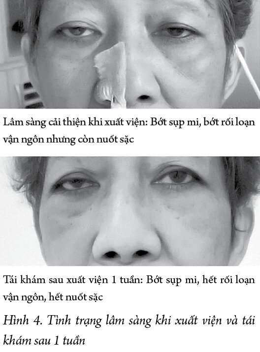 Báo cáo một trường hợp nhược cơ mới khởi phát sau nhiễm SARS-CoV-2 tại thành phố Hồ Chí Minh