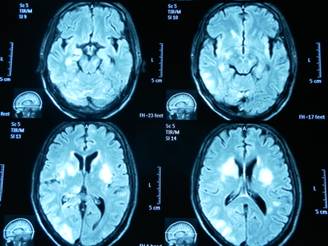 Nghiên cứu một số đặc điểm lâm sàng và hình ảnh chụp cắt lớp vi tính ở bệnh nhân hôn mê do nhồi máu não