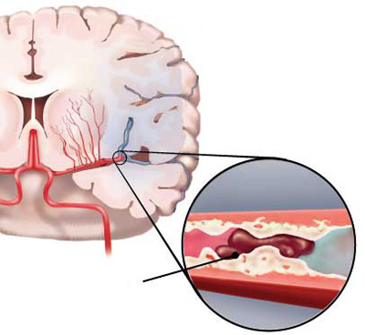 Nghiên cứu đánh giá tiên lượng nhồi máu não theo phân loại Aspect
