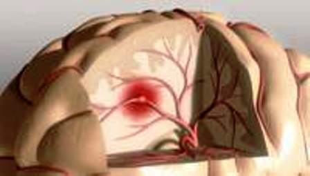 Nghiên cứu đặc điểm lâm sàng, cận lâm sàng và một số yếu tố tiên lượng của chảy mái não bán cầu tại bệnh viện đa khoa trung ương Thái Nguyên