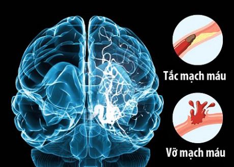 Những “mốc điểm” về nghiên cứu lâm sàng tai biến mạch máu não ở  Việt Nam