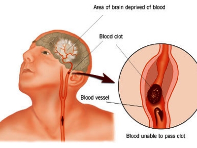 Bệnh mạch máu – thần kinh trong thần kinh học