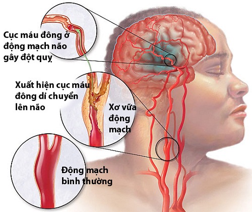 Nghiên cứu nồng độ acid uric huyết tương  ở bệnh nhân đột quị não điều trị tại Bệnh viện Đa khoa trung ương Thái Nguyên