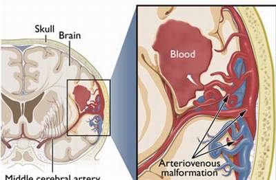 Cập nhật chẩn đoán và điều trị chảy máu não nhu mô