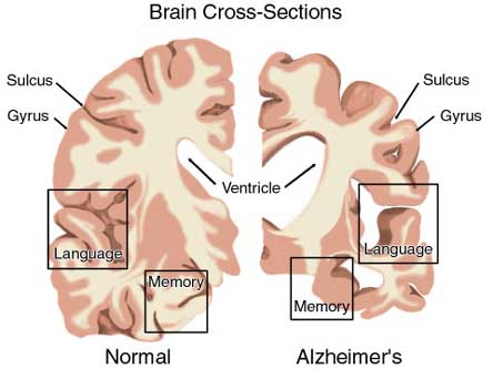 Cập nhật chẩn đoán và điều trị bệnh Alzheimer