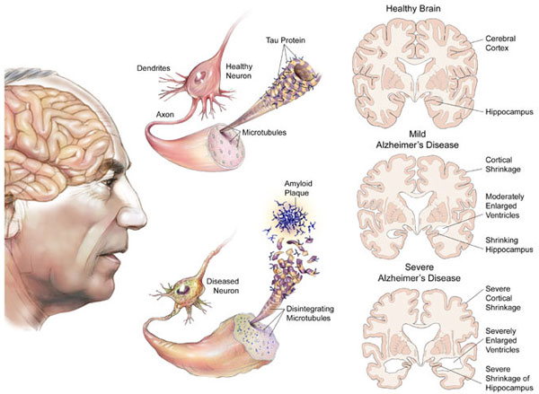 Một số vấn đề cần biết về bệnh Alzheimer