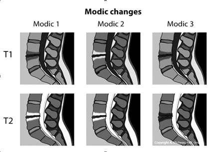 Nghiên cứu một số đặc điểm thay đổi Modic ở bệnh nhân thoát vị đĩa đệm cột sống thắt lưng