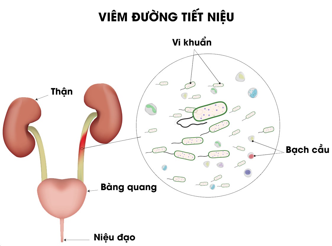 Viêm đường tiết niệu: Cách nhận biết và giải pháp trị hiệu quả – Hội Thần Kinh Học Việt Nam