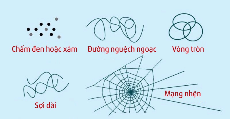 Đục dịch kính – nguyên nhân hàng đầu khiến mắt có đốm đen