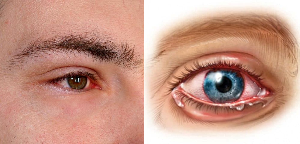Bệnh viêm mắt – Dấu hiệu, cách trị và phòng ngừa tái phát