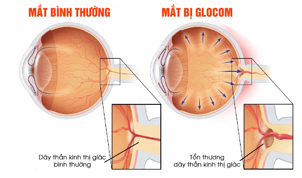 Bệnh glocom (tăng nhãn áp) – Dễ mù lòa nhưng đừng mất hy vọng!