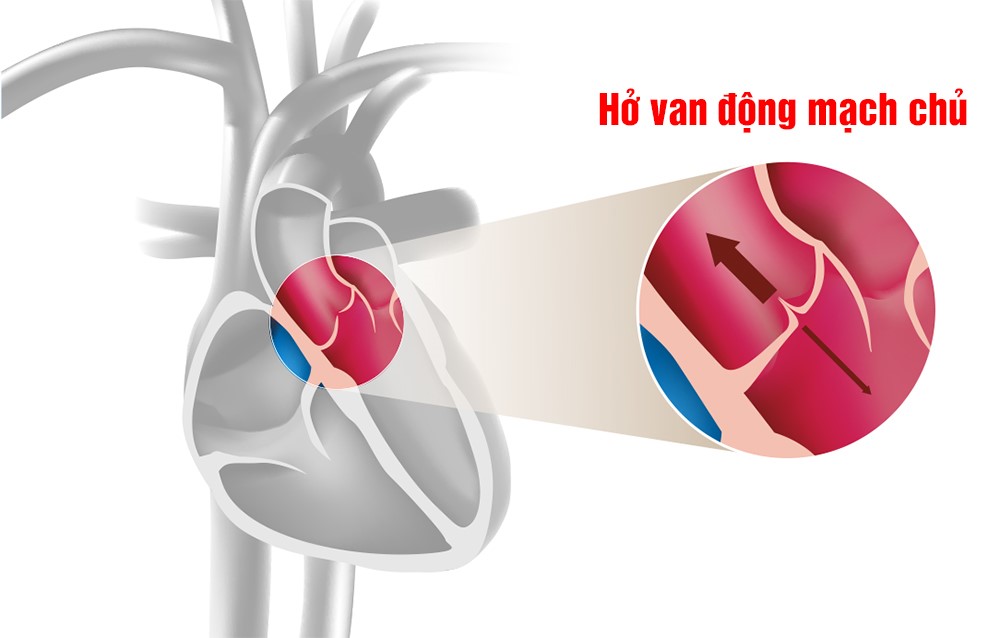 Hở van động mạch chủ – Bệnh van tim nguy hiểm không thể chủ quan
