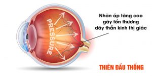 Thiên đầu thống – Giải pháp điều trị để ngăn mù lòa