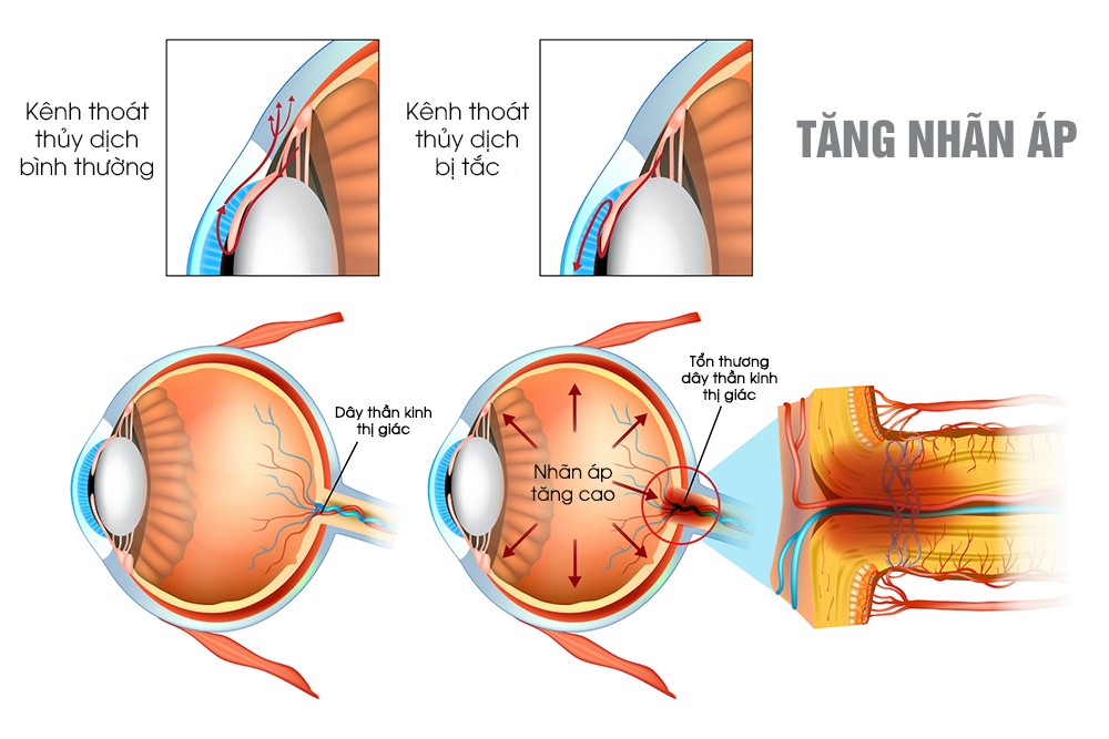 Đừng để mù lòa vì bệnh glocom góc mở (tăng nhãn áp góc mở)