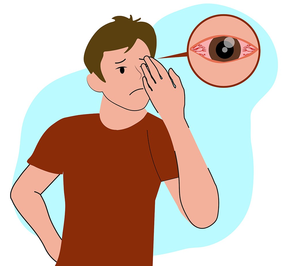 Viêm giác mạc – Rất dễ mù lòa nếu điều trị sai cách!