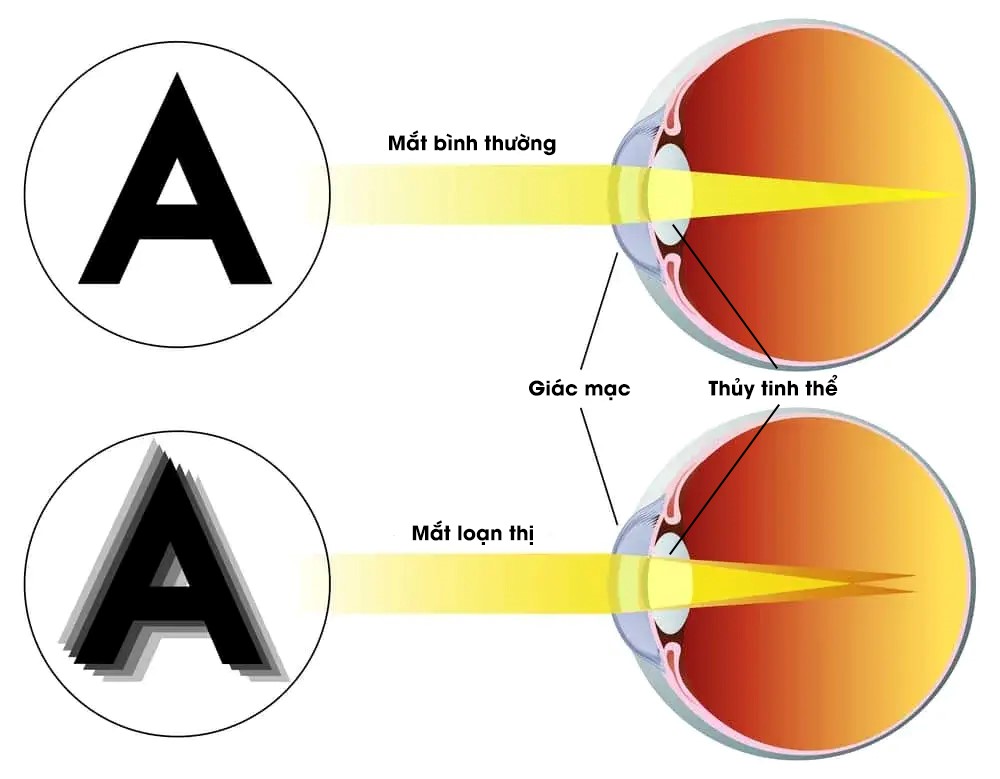 Loạn thị – Những thông tin cần nắm rõ để mắt sáng khỏe
